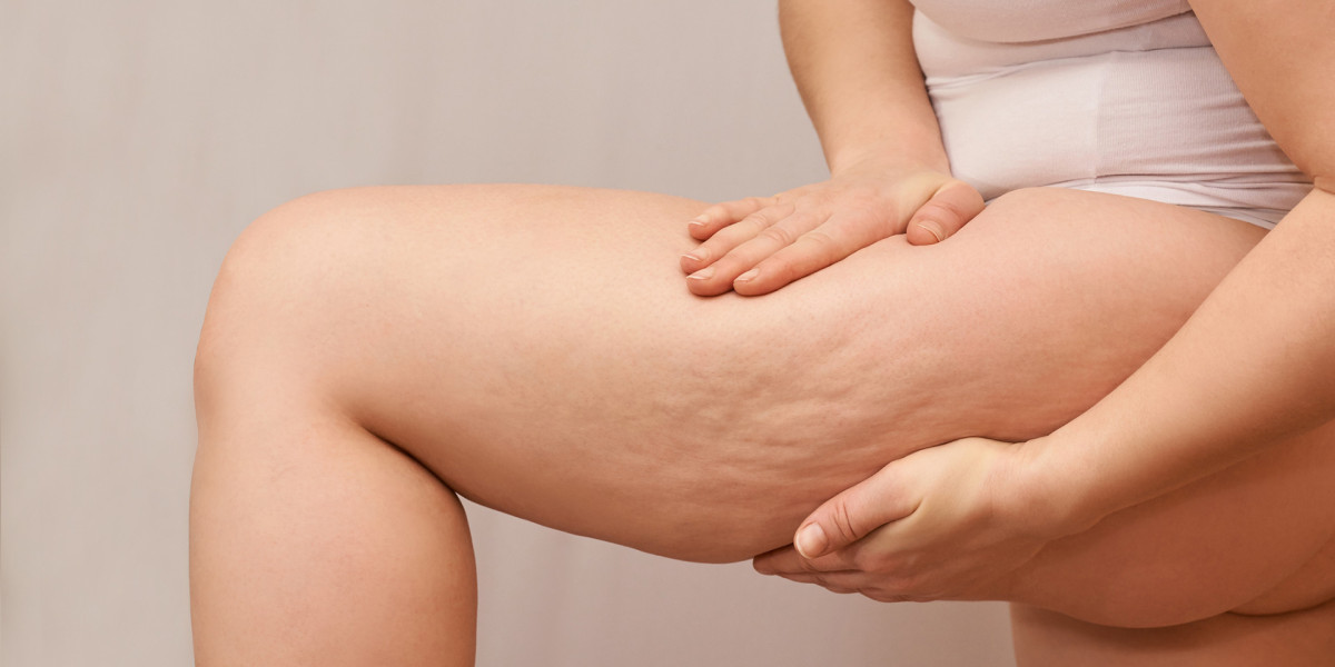 Is cellulite unavoidable?