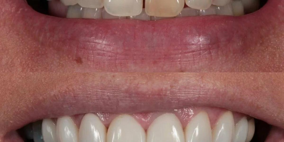 What cleans composite bonding?