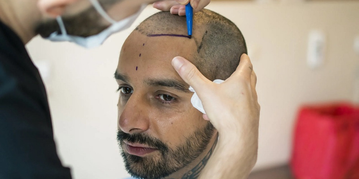 In which cases hair transplant fails?