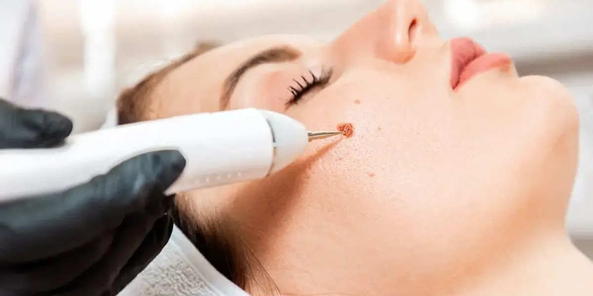 How do you know if you have successfully removed a wart?