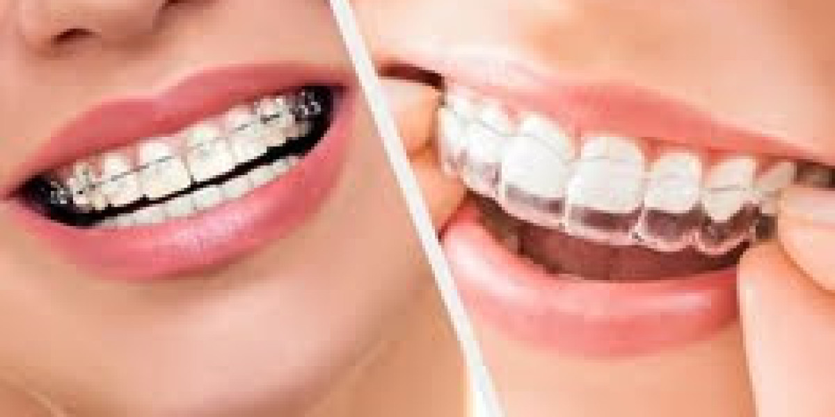 Best Dentist for Braces in Hoodi Bangalore: Your Guide to a Confident Smile