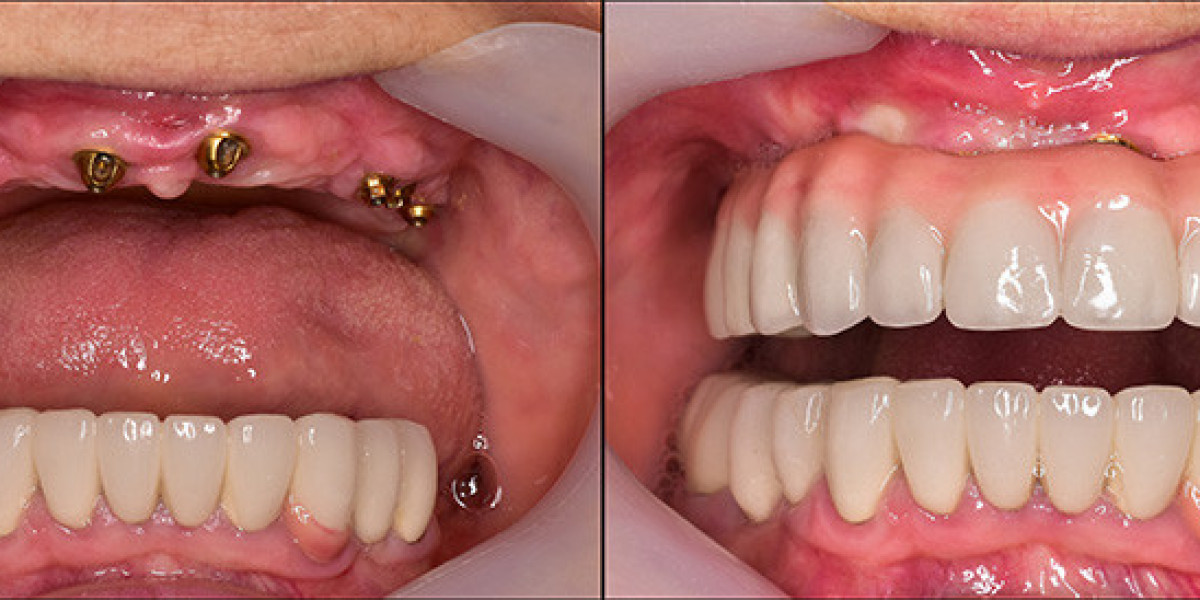 Restore Your Smile with Dental Implants in Batavia, IL