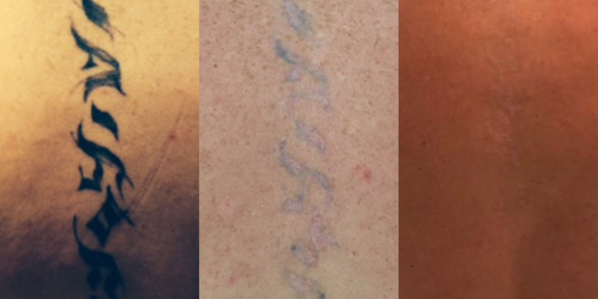 Laser Tattoo Removal London: The Complete Guide
