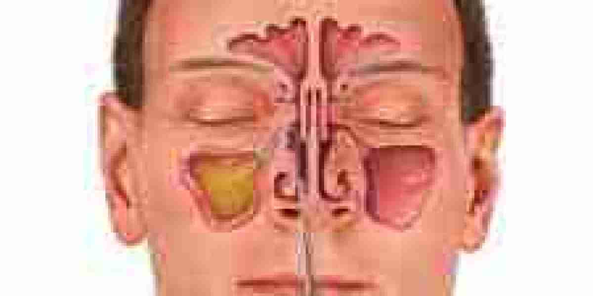 Understanding Turbinate Reduction in Los Angeles: A Guide to Better Breathing