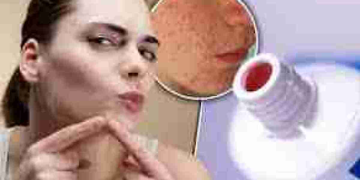 The Complete Guide on How to Get Rid of Breakouts and Remove Pimples Naturally and Permanently