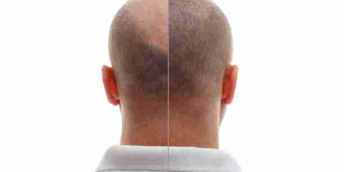 How Has Hair Transplant Technology Improved Over the Last Decade?