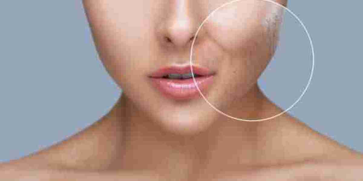 Laser Acne Treatment Recovery: Quick Tips for Smooth Healing