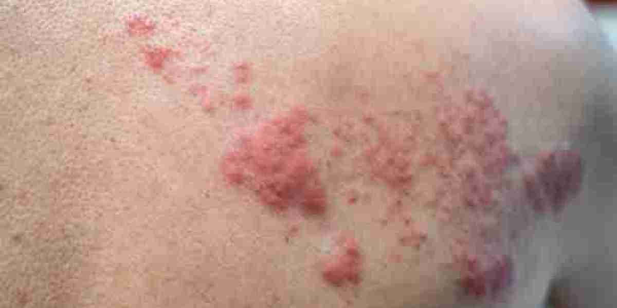 كيف يؤثر الإجهاد والتوتر على تفشي نوبات الحزام الناري؟