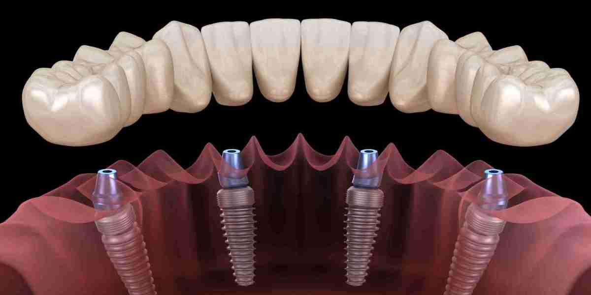 Dental Implants After Injury: What Patients Should Know