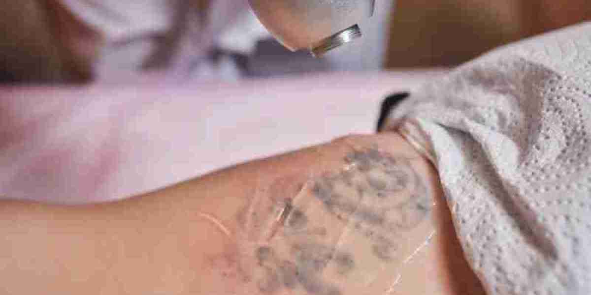 إزالة الوشم بالليزر لتحقيق مظهر بشرة أكثر صفاءً