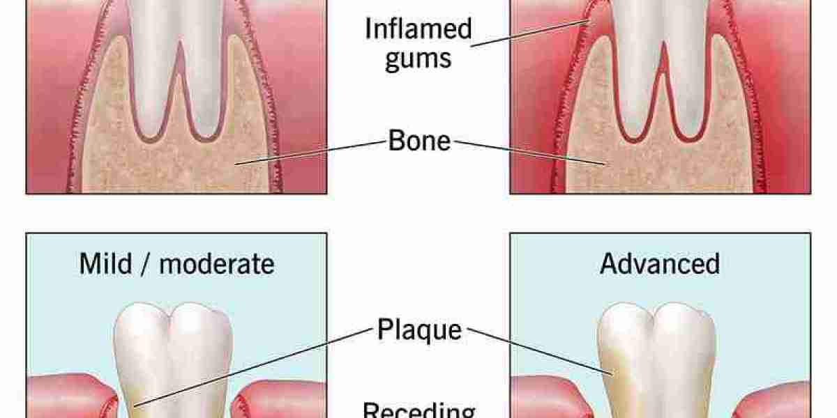 Periodontitis and Its Connection to Overall Health