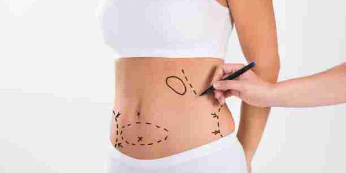 Laser Liposuction for Modern Non-Surgical Fat Removal