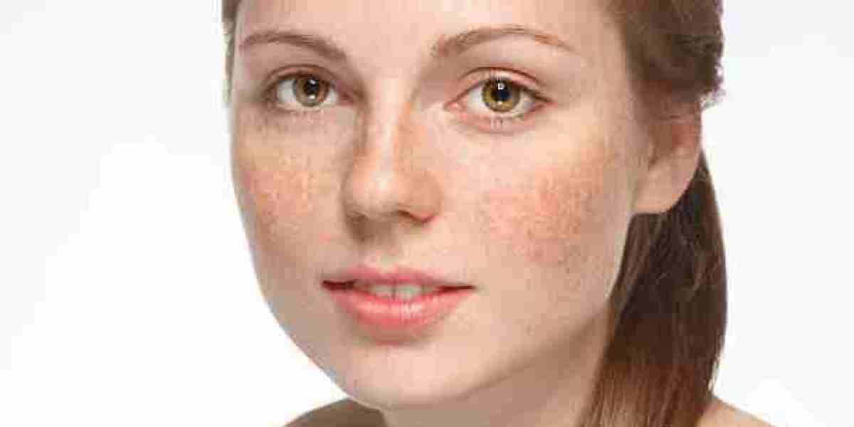Gentle Melasma Treatment for Sensitive Skin