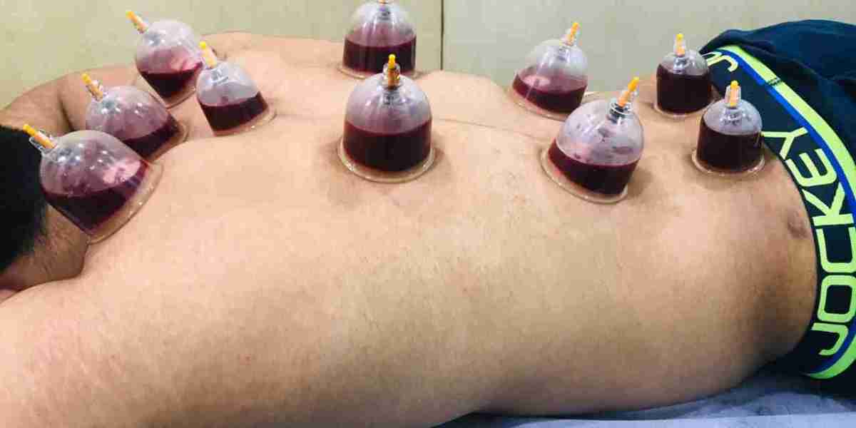 Unlock Total Wellness with Hijama Cupping Therapy for Your Body
