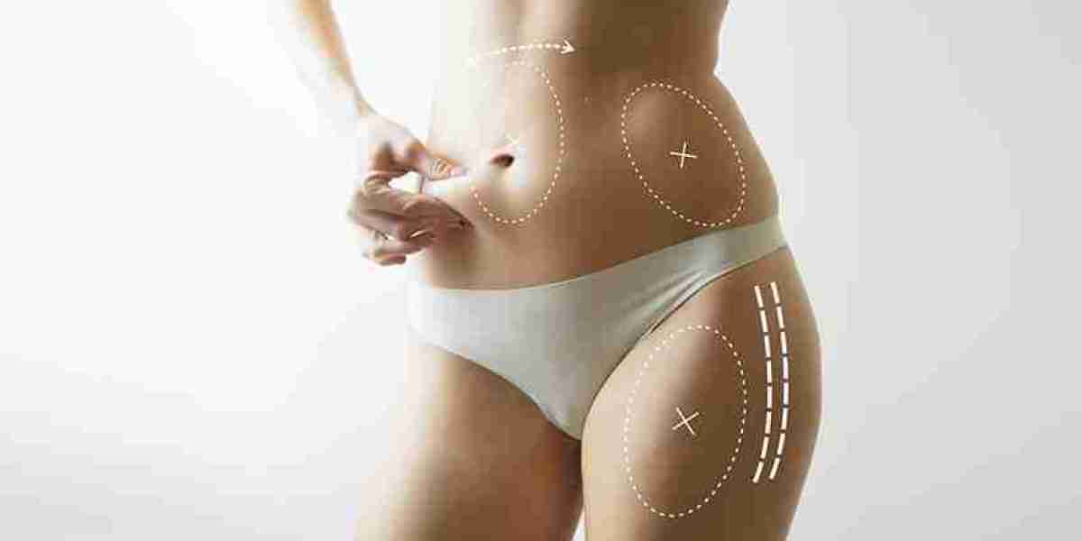 Exercise After Liposuction: When and How to Start