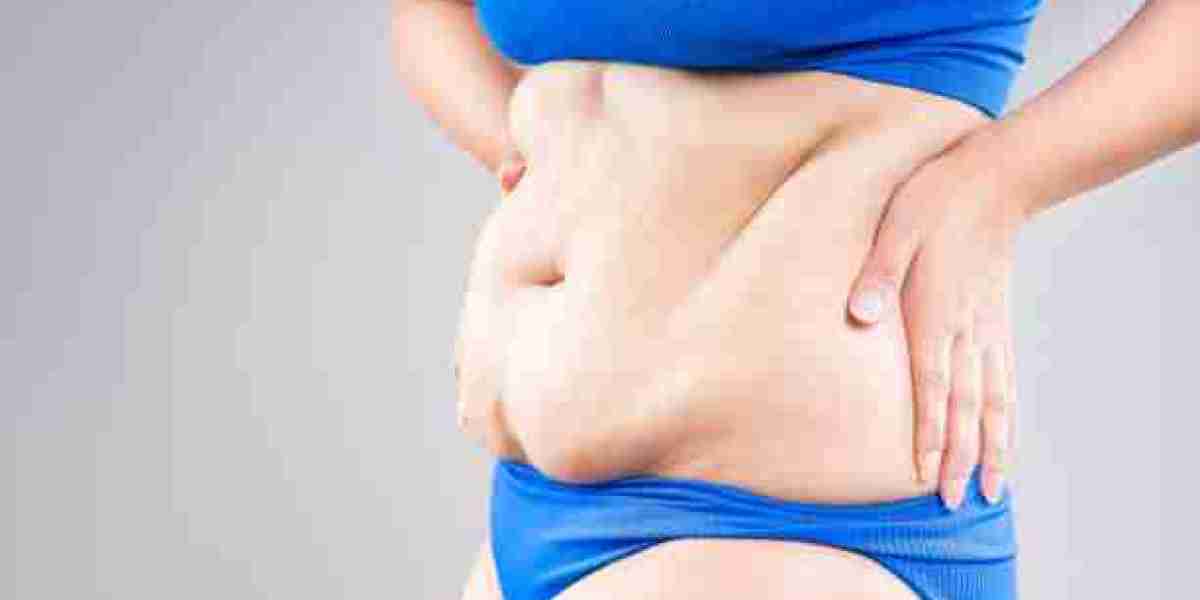 Exercise After Tummy Tuck Surgery: Safe Return Tips