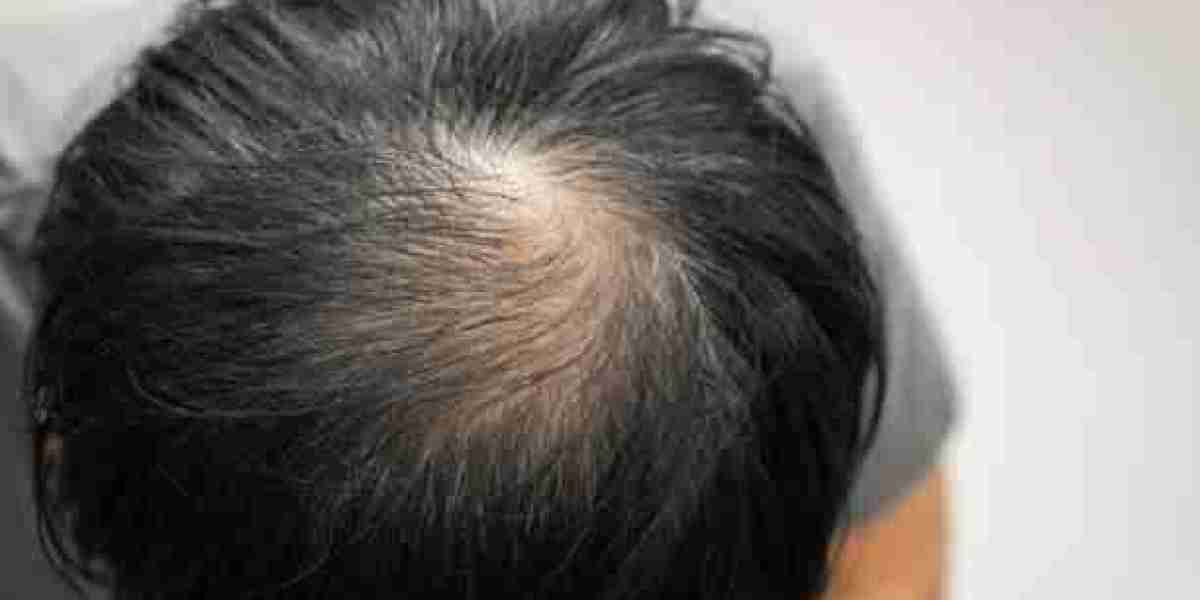 What Makes Exosomes Therapy for Hair Loss Effective