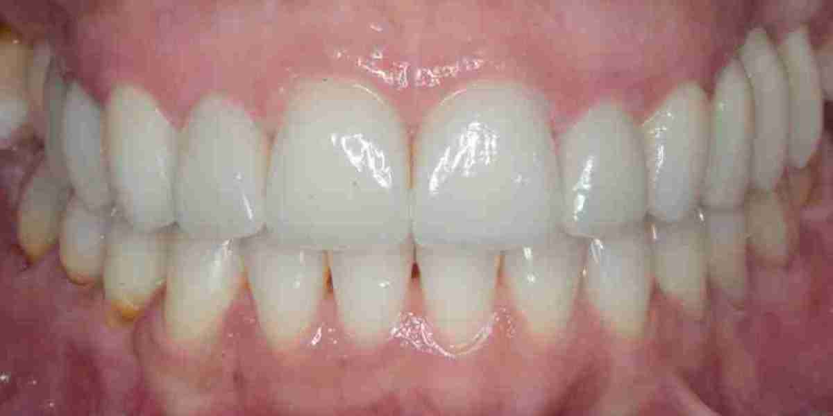 Enhance Dental Health and Smile with Powerful Dental Activators