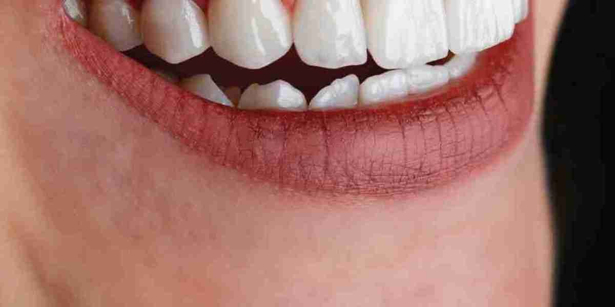 Redefine Smile Confidence with Composite Veneers Instantly
