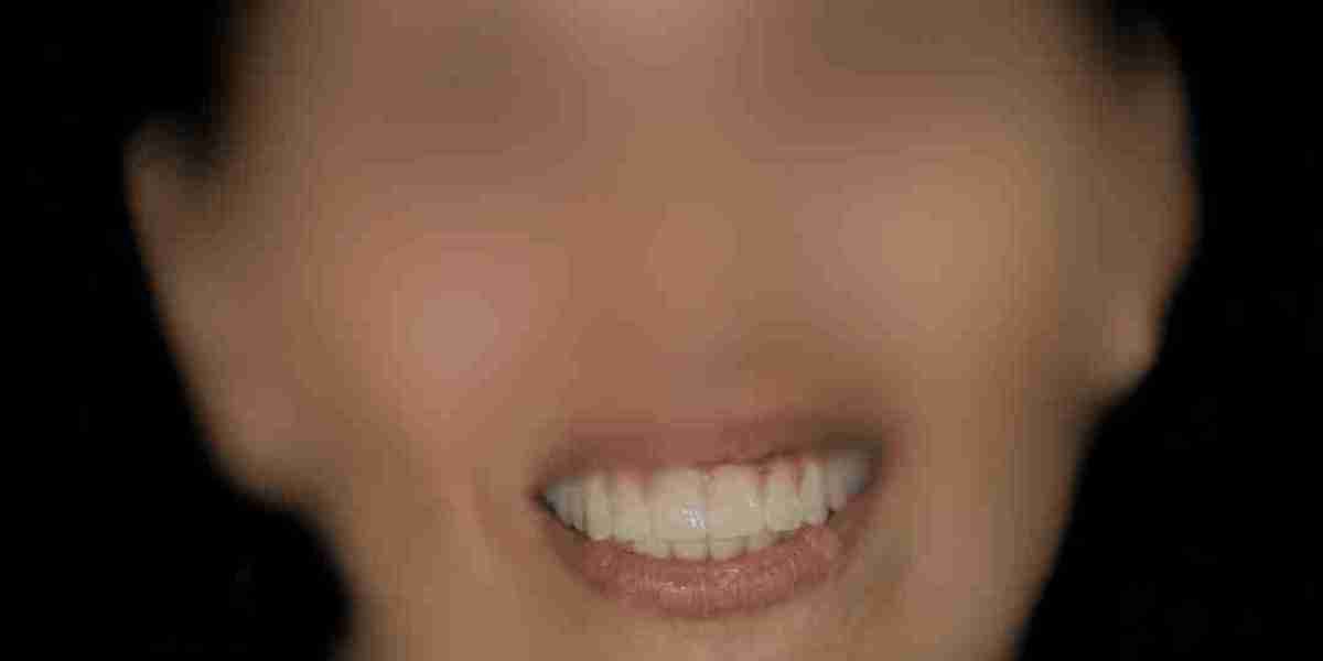 Implante Dental en Hospitalet de Llobregat Recupera tu Sonrisa