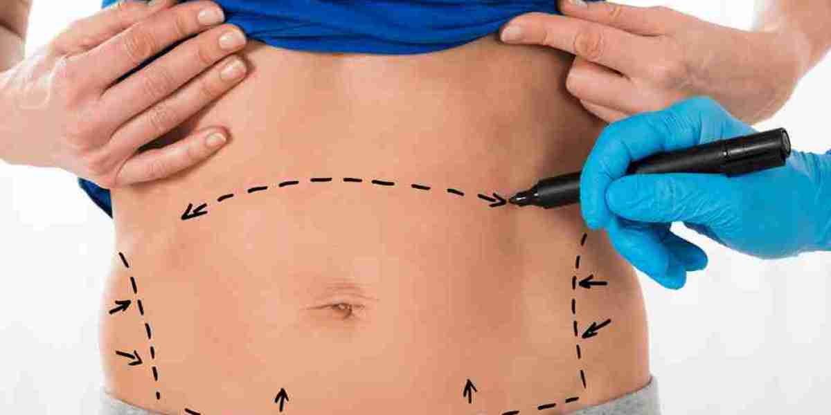 Key Things You Should Know Before a Tummy Tuck