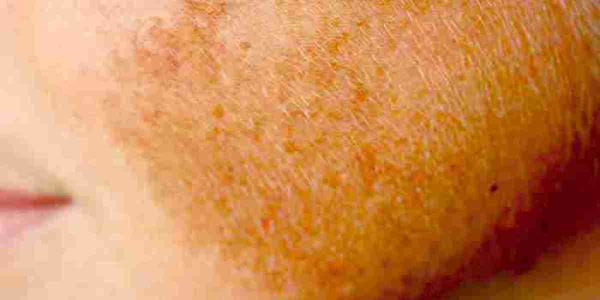 Achieve Clearer Skin Instantly with Effective Melasma Treatment