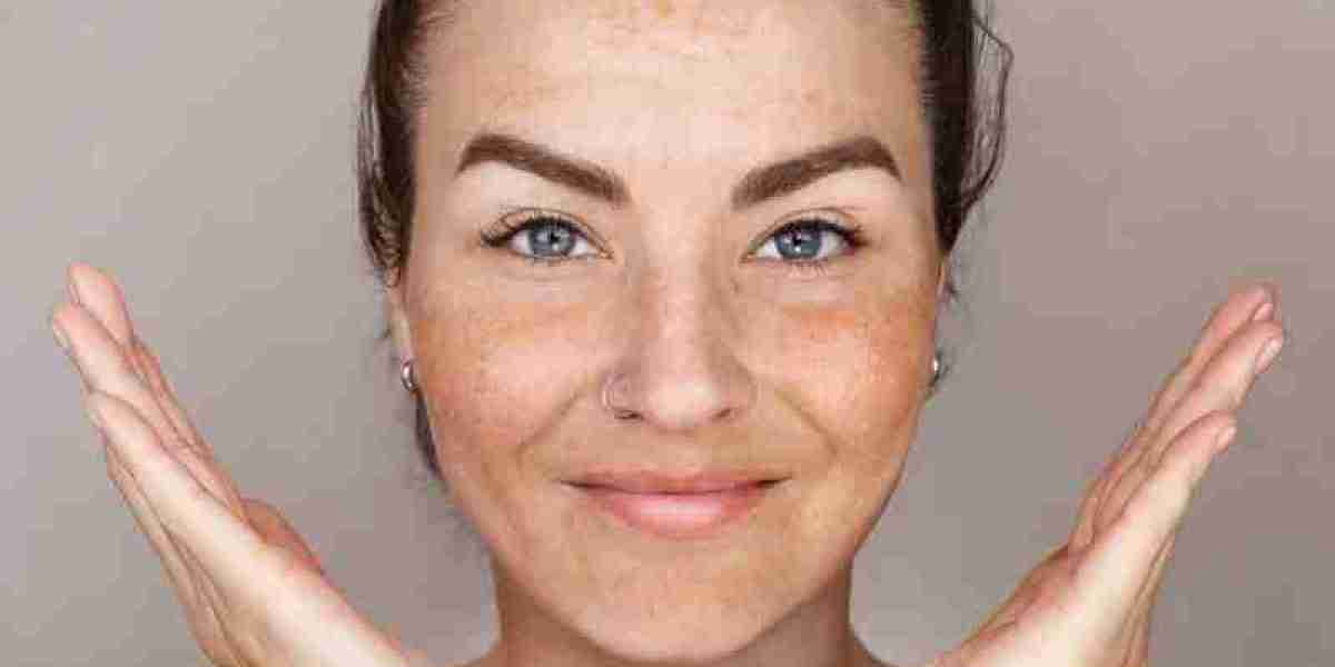 Melasma: Clinical Care Explained