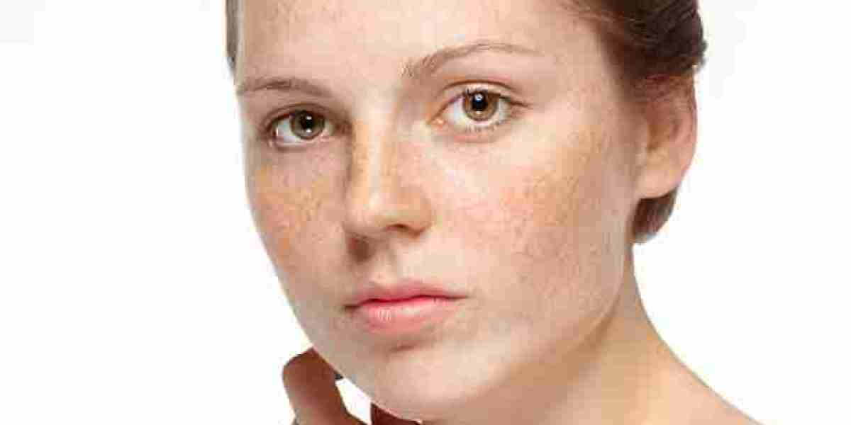 Pico Laser Treatment Advantages Over IPL for Skin Renewal