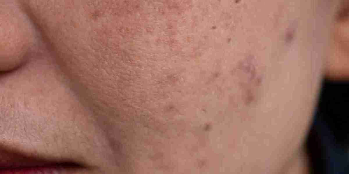 Melasma treatment in Islamabad Pro Care