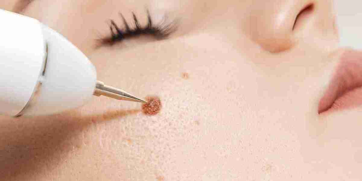 Remove Warts Quickly – Best Clinics in Islamabad