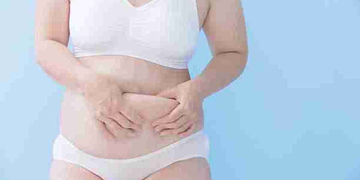Tummy Tuck Surgery for Loose Skin: Solutions After Major Weight Loss