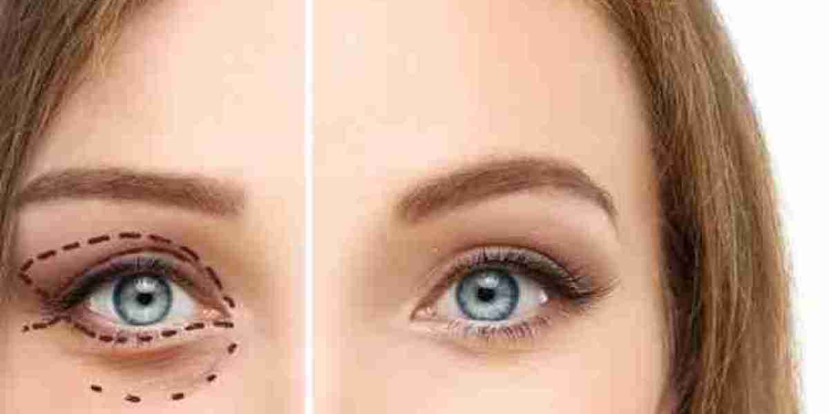 Eye Bag Removal in Riyadh Boosts Confidence and Appearance Fast