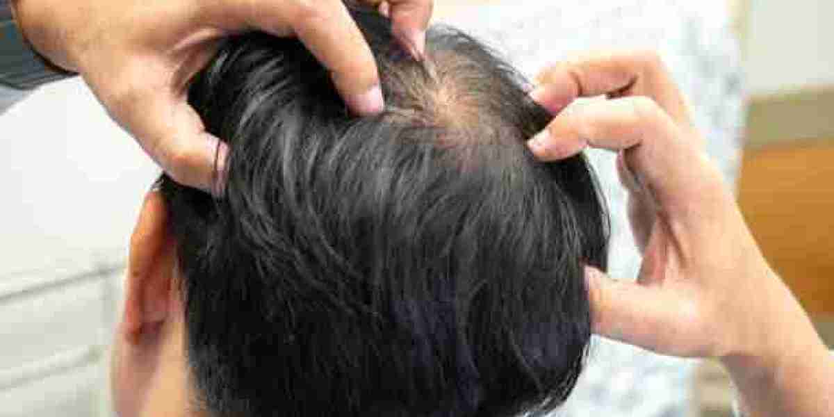 Elevate Hair Growth Using Exosomes Therapy for Hair Loss in Riyadh