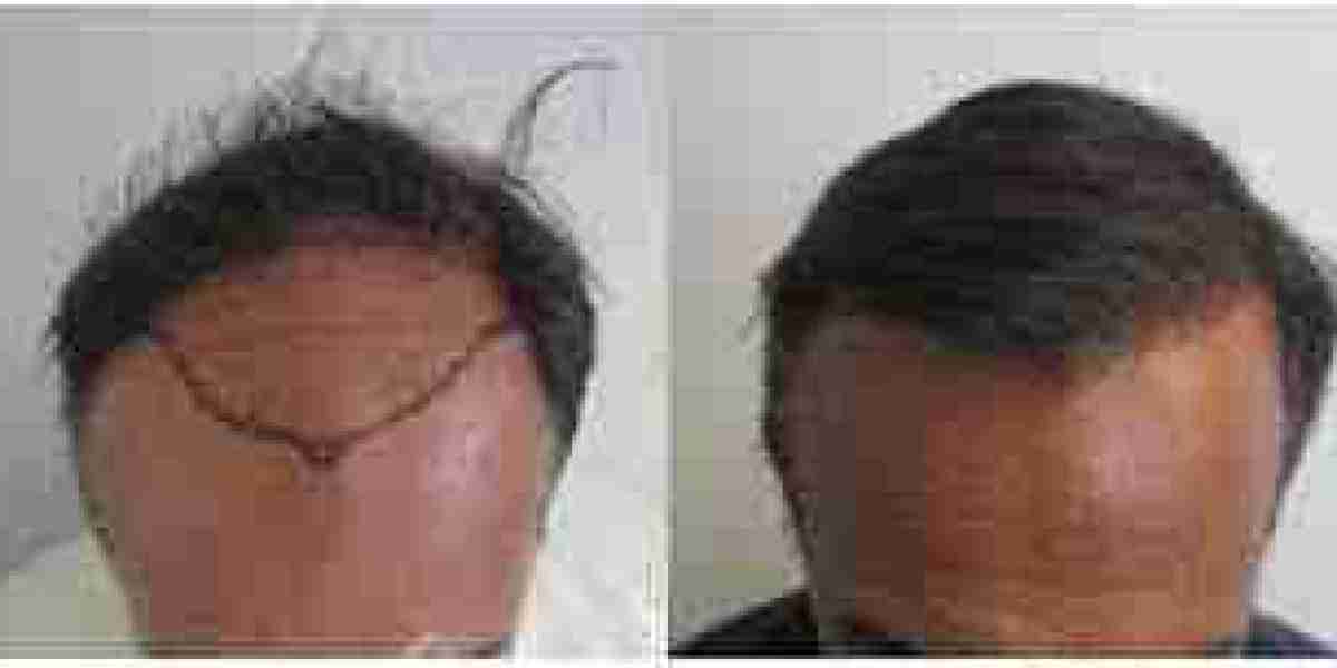 How Does Hair Restoration for Men Improve Confidence, Career Presence, and Overall Appearance?