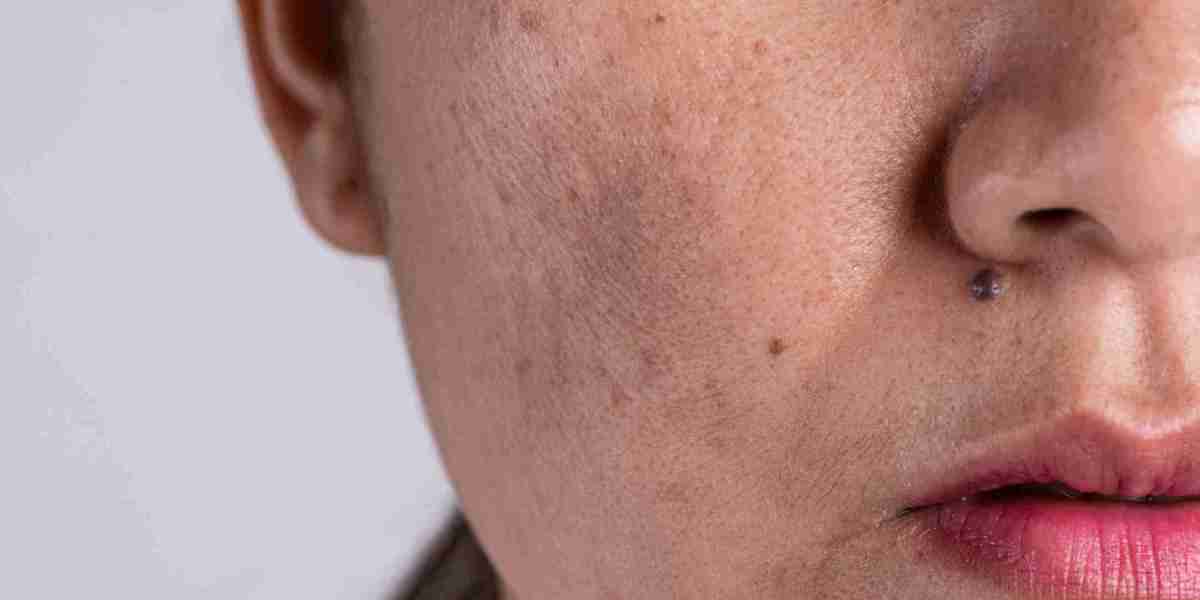 Get Even Skin Tone Quickly with Advanced Melasma Treatment
