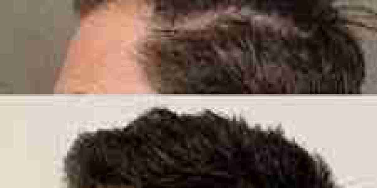 Why Are Patients Choosing Hair Transplant Manhattan Beach Clinics for Hair Restoration?