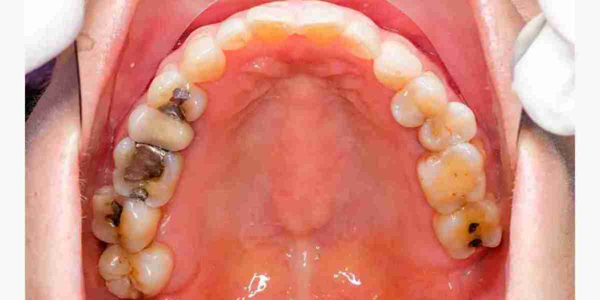 How Long Should Your Dental Tooth Filling Last