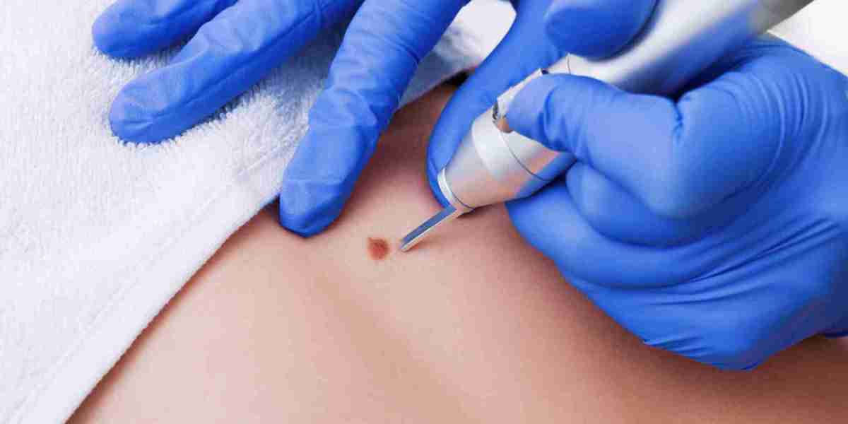 Trusted Skin Experts for Mole Removal