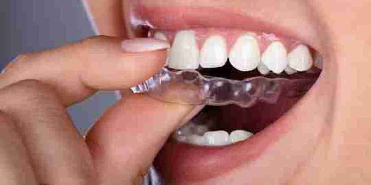 Teeth Aligners – Smile Confidently with Clear Aligners