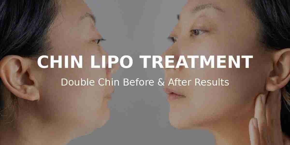 Say Hello to a Sleeker Chin: Chin Lipo Treatment in Islamabad