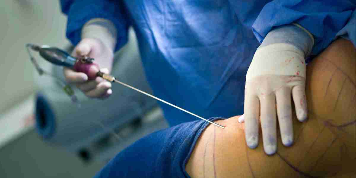 Love Handle Liposuction Explained: A Complete Guide to Achieving a Slimmer Waistline