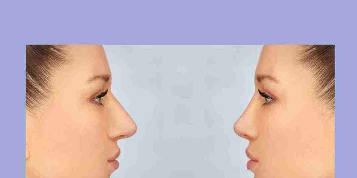 Best Chin Augmentation Surgeon in Delhi for Natural Facial Balance and Defined Jawline