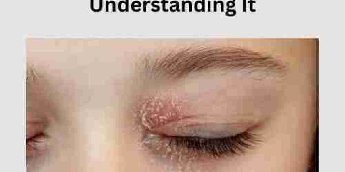 Blepharitis Contagious or Not? A Complete Guide to Understanding It