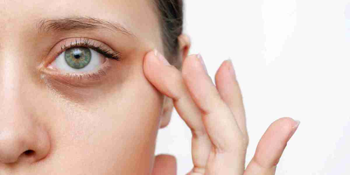 Myths and Facts About Dark Circles