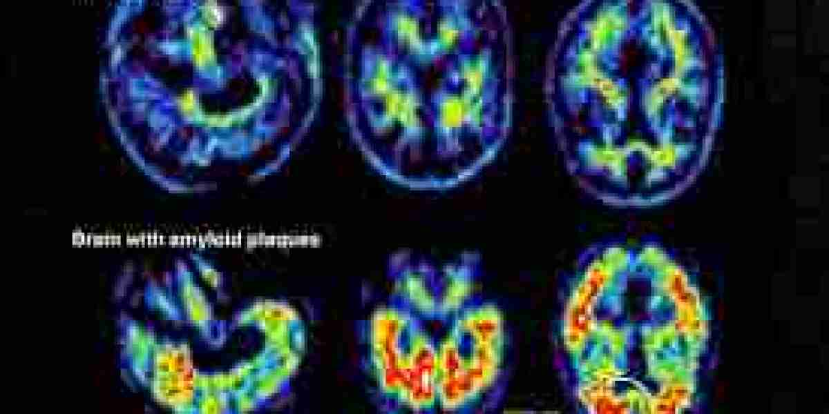 Alzheimer’s Disease Diagnostic Market Forecast to Reach New Heights by 2032