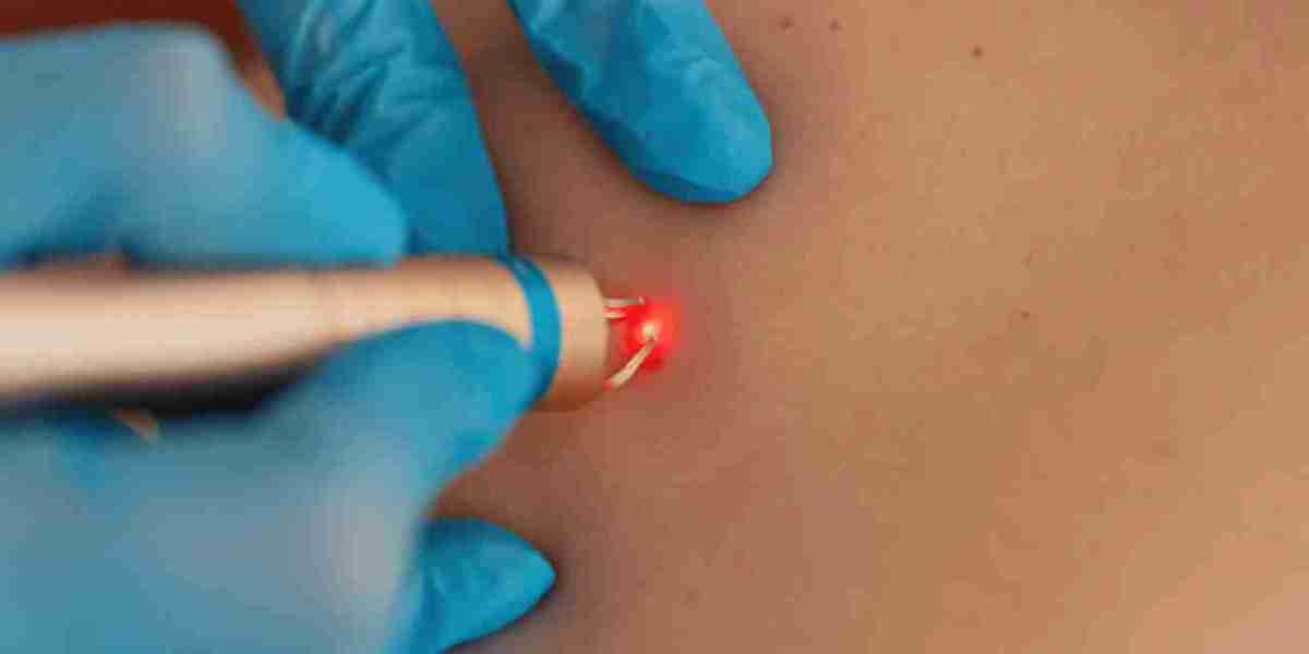 Skin Tags Removal in Dubai – Smooth Skin with Expert Care