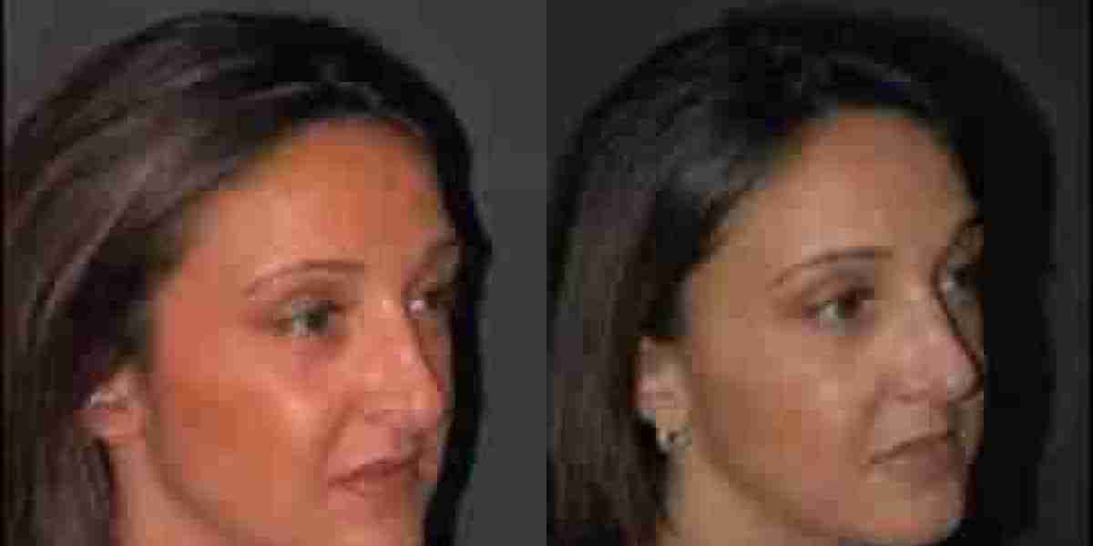 مكياجك بعد تجميل الأنف: متى وكيف تبرزين جمالك الجديد؟