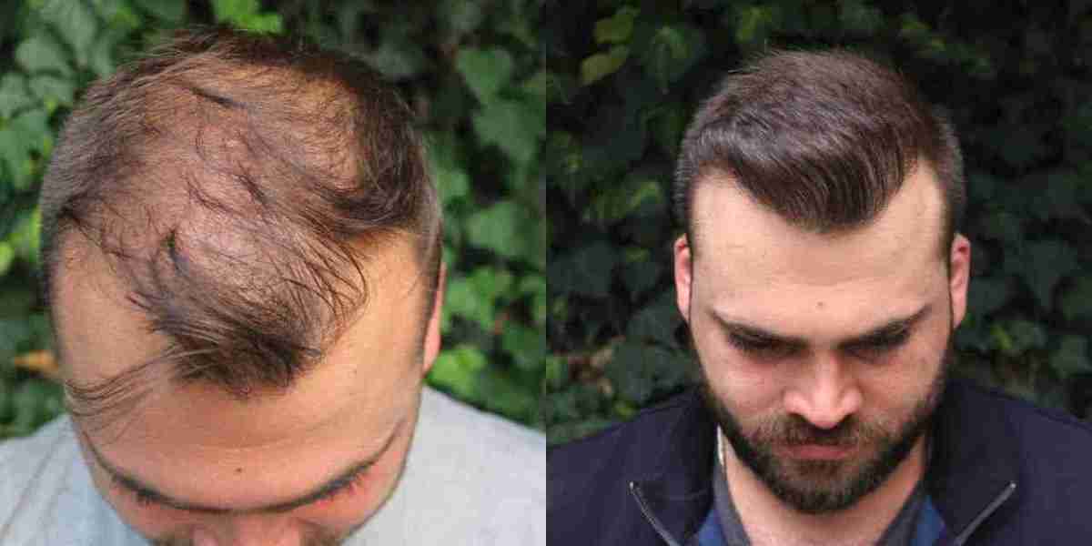 زراعة الحواجب في دبي: حلول دائمة لمظهر عيون ساحر