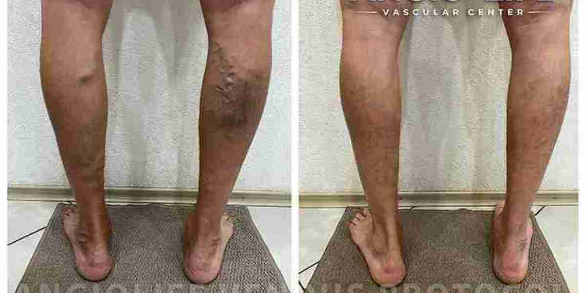 Естетична флебологія: як повернути красу ніг без операцій