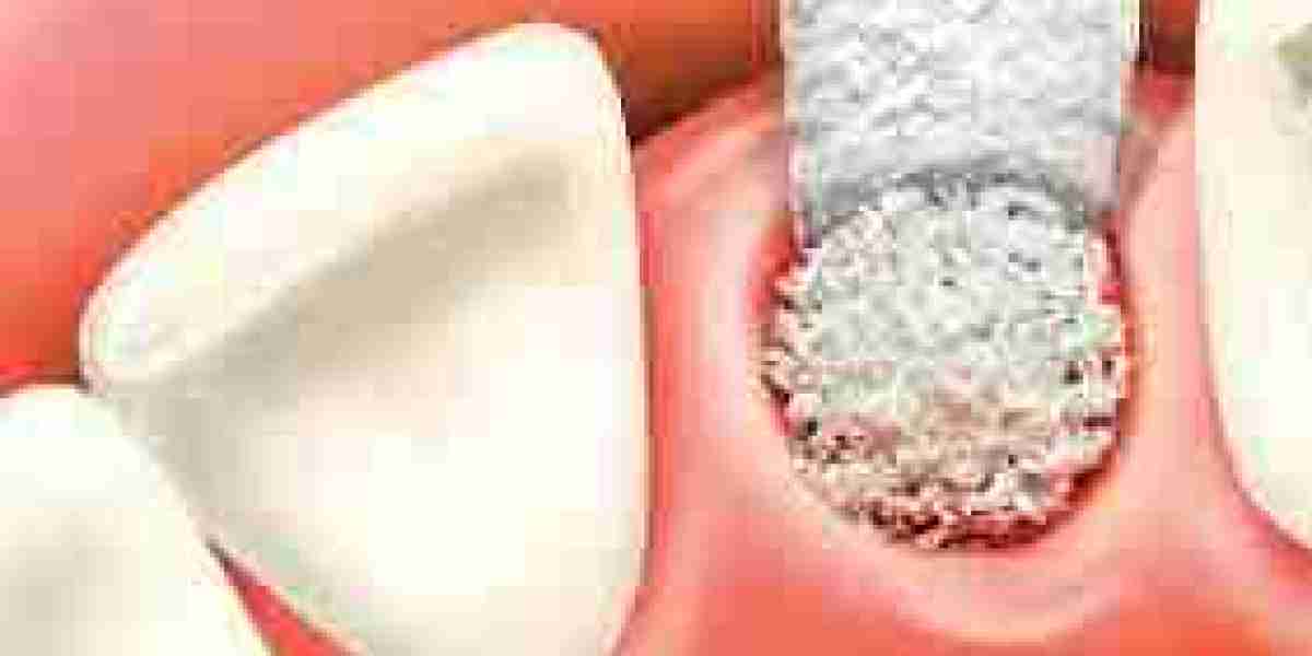 Dental Implant Bone Grafting Market Forecast (2025–2034): Technology and Demand Trends